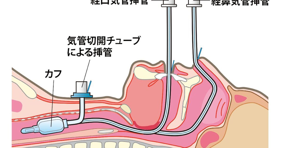 人工 呼吸 器 仕組み