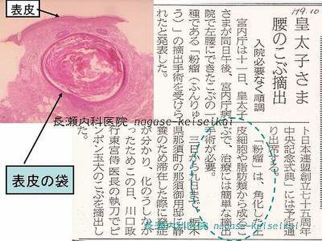 ニキビが治らない 日に日に大きくなっていく それ 粉瘤 ふんりゅう かも Togetter