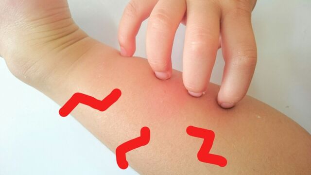 閲覧注意 甘く見てはならない 虫刺され リンパに沿って炎症 おかしいと思ったら 早めに病院へ Togetter